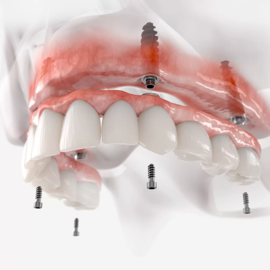 Dentes-fixos-num-dia