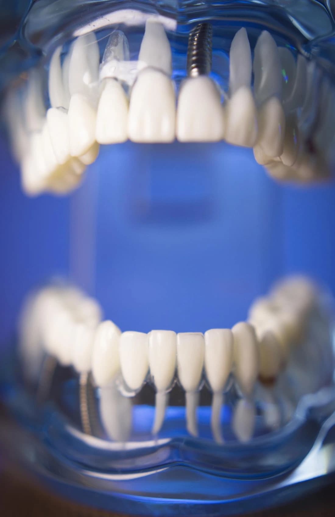 Paciente a receber tratamento de implantes dentários na CC Clinic, em
Águeda.